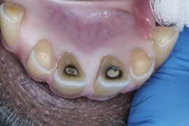 圖4. 狒狒門齒進行根管治療並填補牙洞